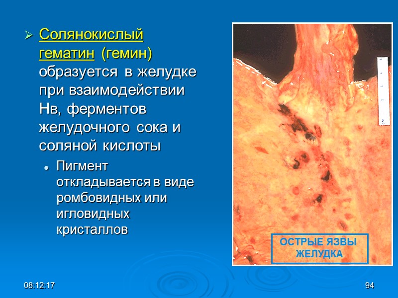 08:12:02 94 Солянокислый гематин (гемин) образуется в желудке при взаимодействии Нв, ферментов желудочного сока